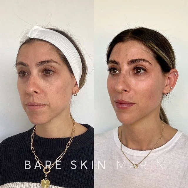 Skin Treatment before and after Images by Bare Skin Marin in Kentfield, CA