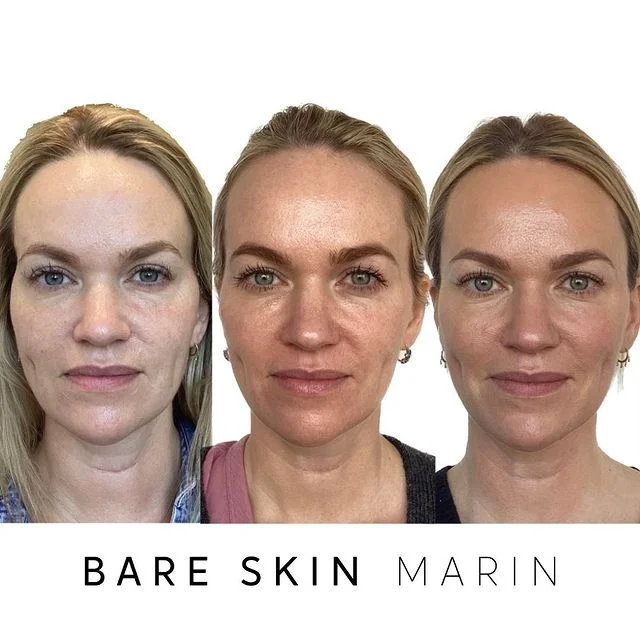 Skin Treatment before and after Images by Bare Skin Marin in Kentfield, CA