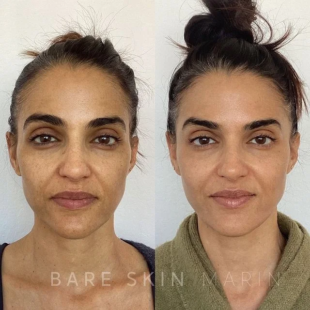 Skin Treatment before and after Images by Bare Skin Marin in Kentfield, CA