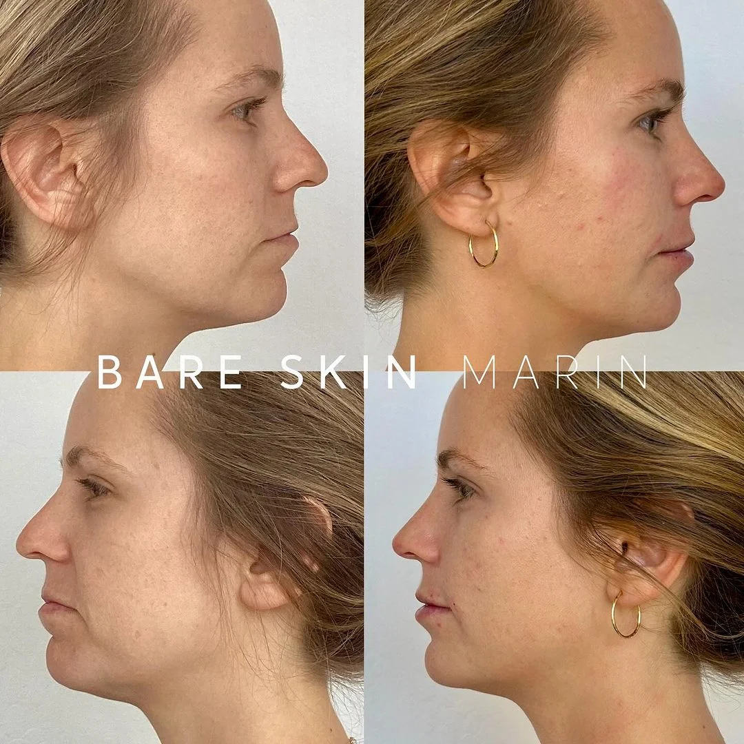 Skin Treatment before and after Images by Bare Skin Marin in Kentfield, CA