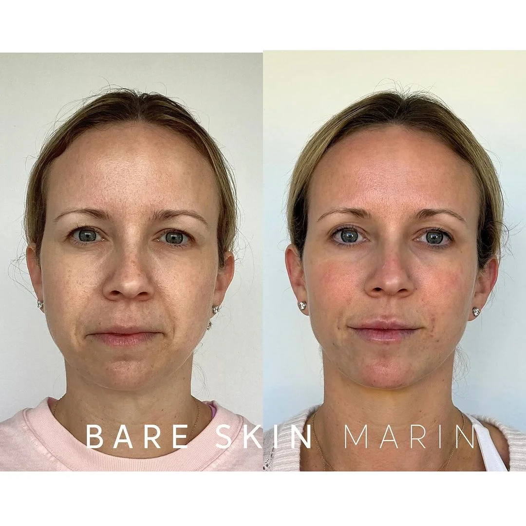 Skin Treatment before and after Images by Bare Skin Marin in Kentfield, CA