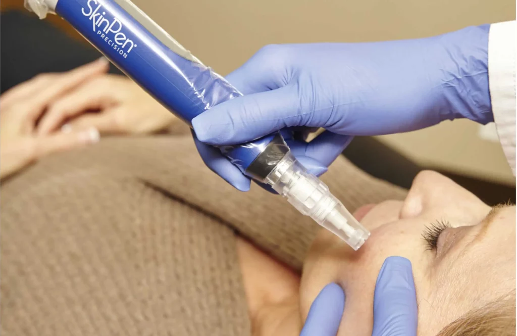 Microneedling in Kentfield, CA at Bare skin Marin