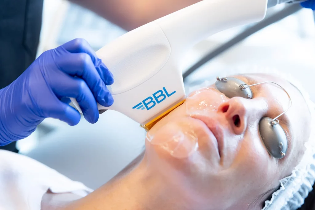 BBL HEROic Treatments in Kentfield, CA at Bare Skin Marin