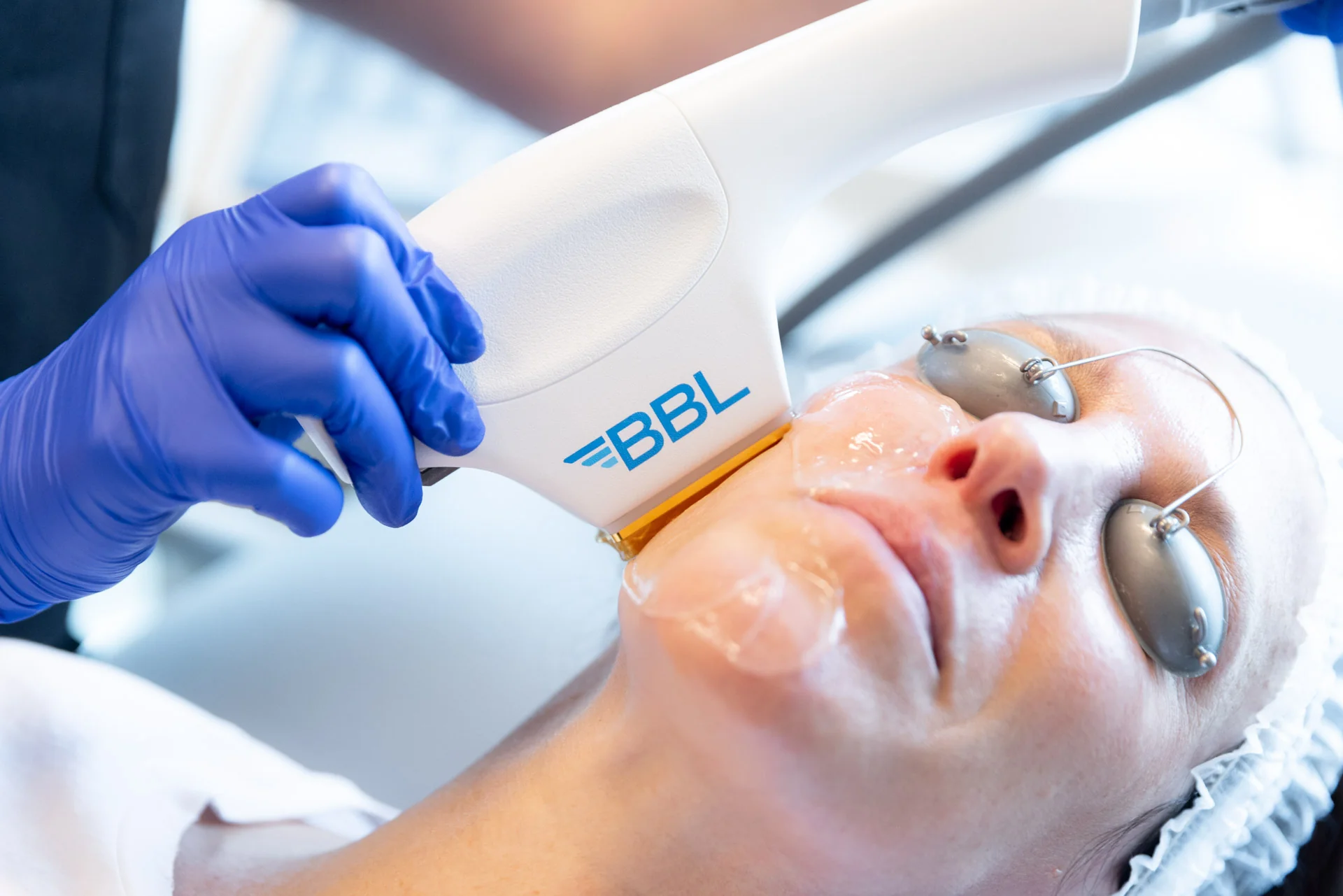 BBL HEROic Treatments in Kentfield, CA at Bare Skin Marin