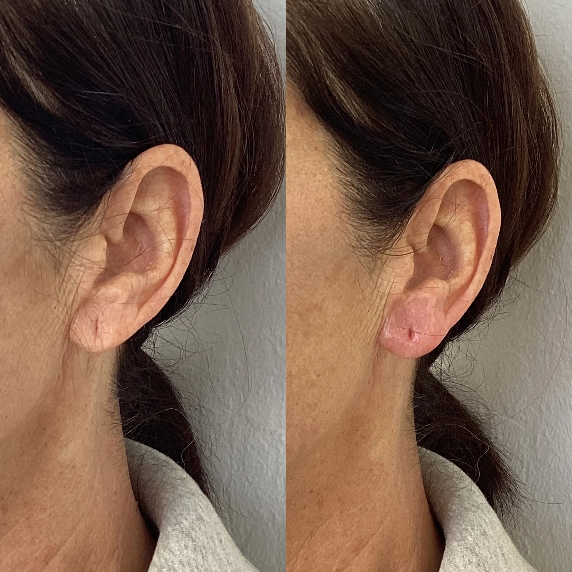 Skin Treatment before and after Images by Bare Skin Marin in Kentfield, CA