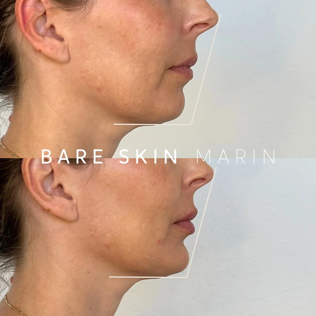 Skin Treatment before and after Images by Bare Skin Marin in Kentfield, CA