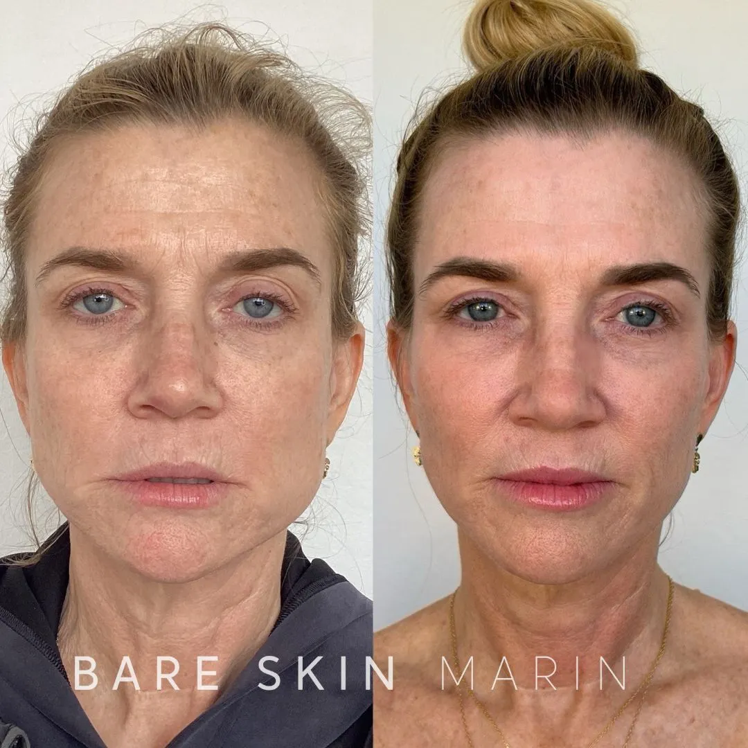 Skin Treatment before and after Images by Bare Skin Marin in Kentfield, CA