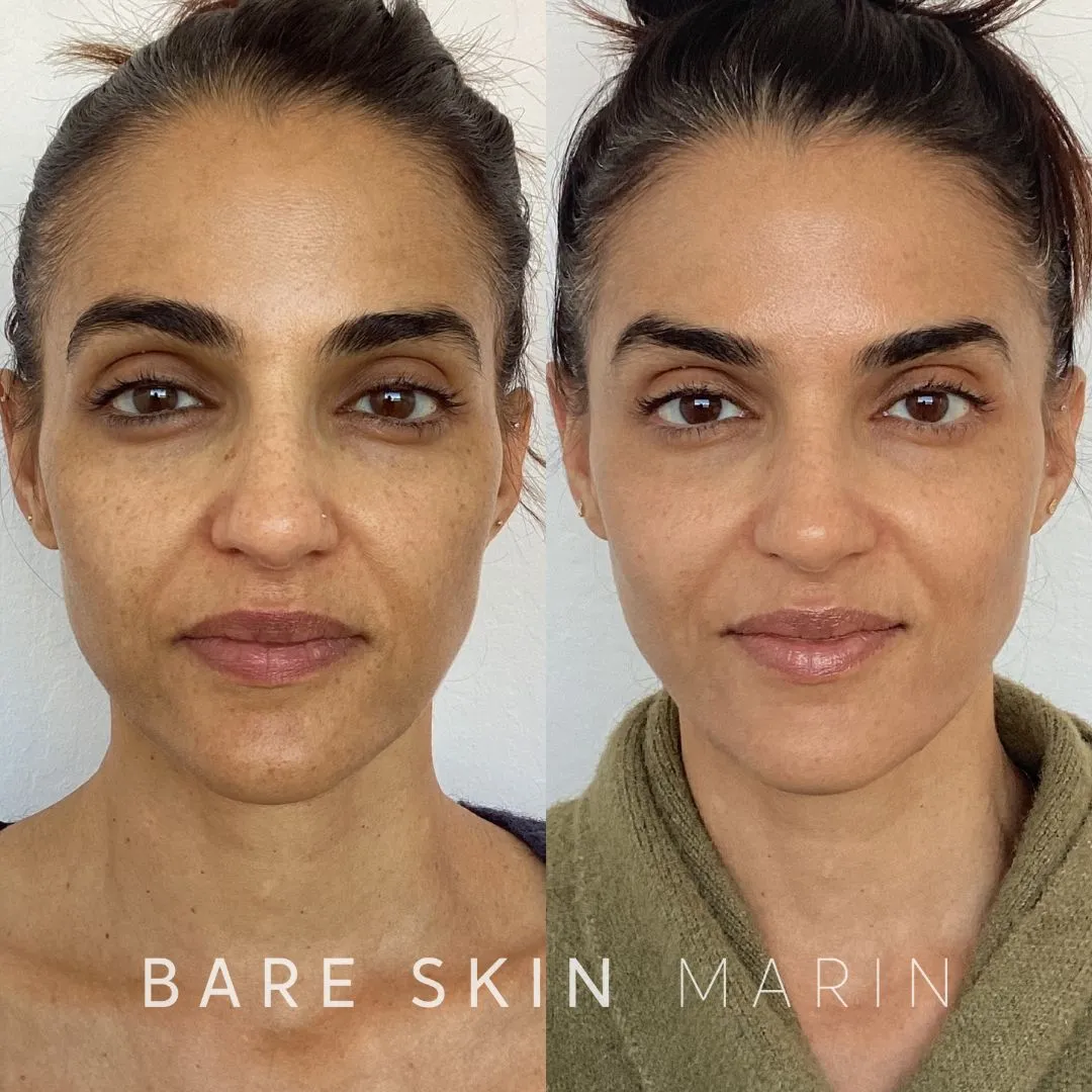 Skin Treatment before and after Images by Bare Skin Marin in Kentfield, CA