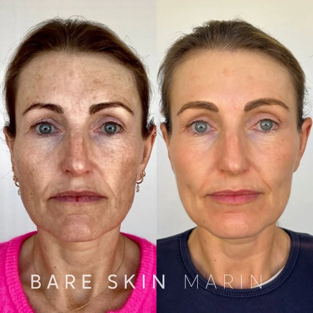 Skin Treatment before and after Images by Bare Skin Marin in Kentfield, CA