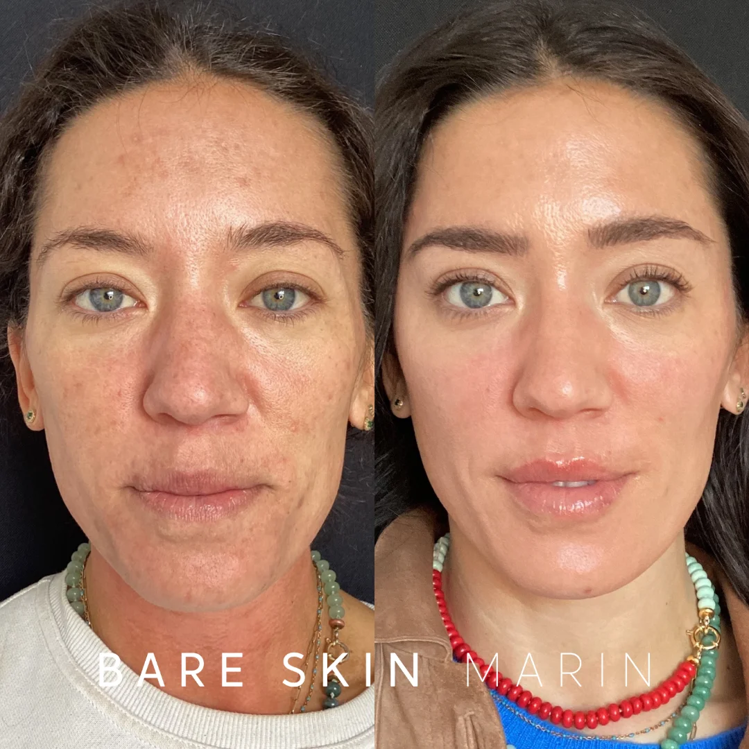 Skin Treatment before and after Images by Bare Skin Marin in Kentfield, CA