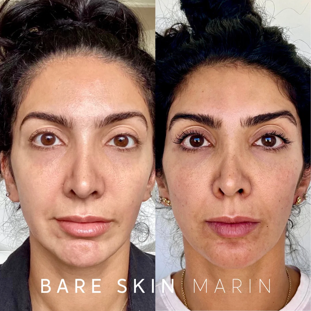Skin Treatment before and after Images by Bare Skin Marin in Kentfield, CA