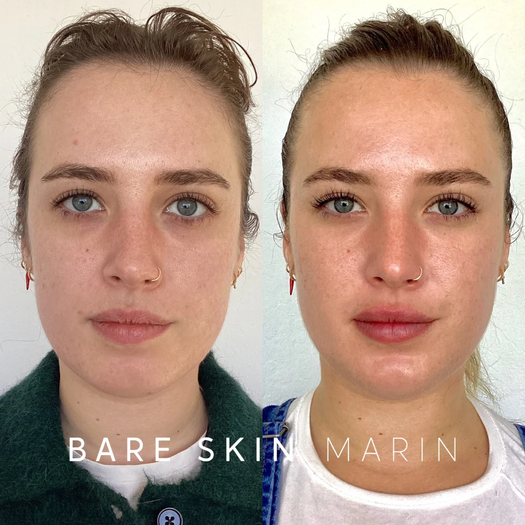 Skin Treatment before and after Images by Bare Skin Marin in Kentfield, CA