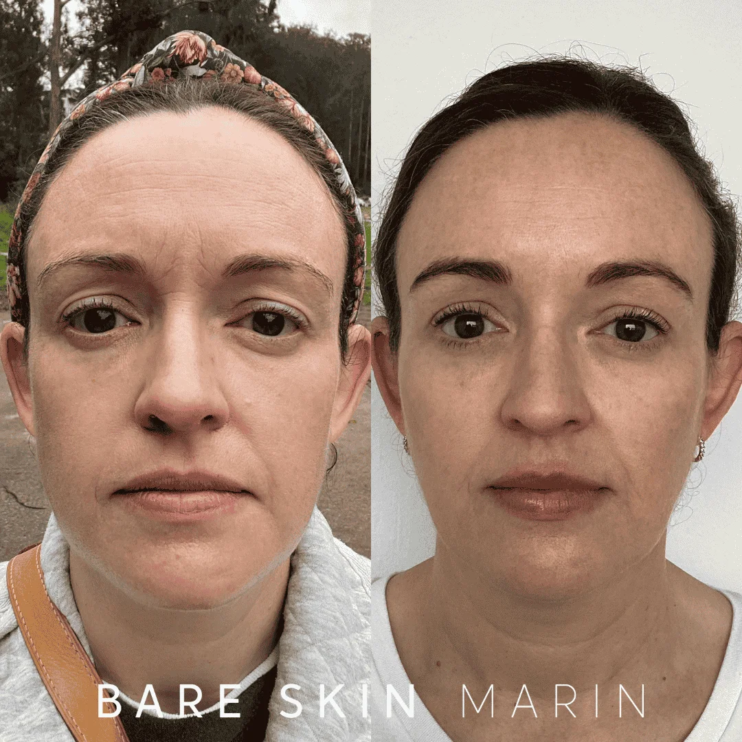 Skin Treatment before and after Images by Bare Skin Marin in Kentfield, CA