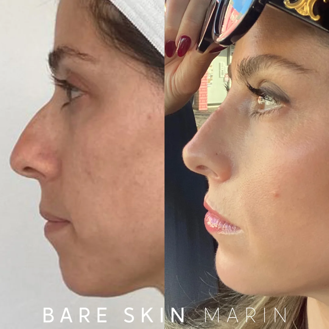 Skin Treatment before and after Images by Bare Skin Marin in Kentfield, CA