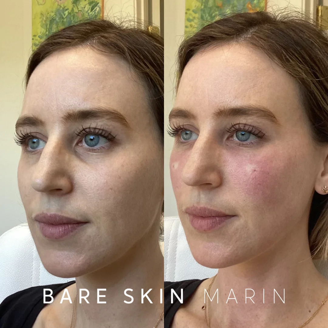 Skin Treatment before and after Images by Bare Skin Marin in Kentfield, CA