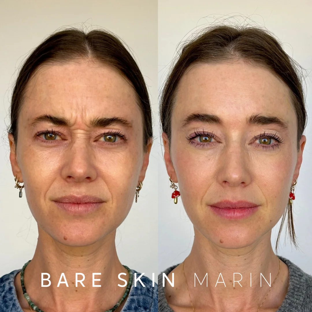 Med Spa Services before and after Images by Bare Skin Marin in Kentfield, CA