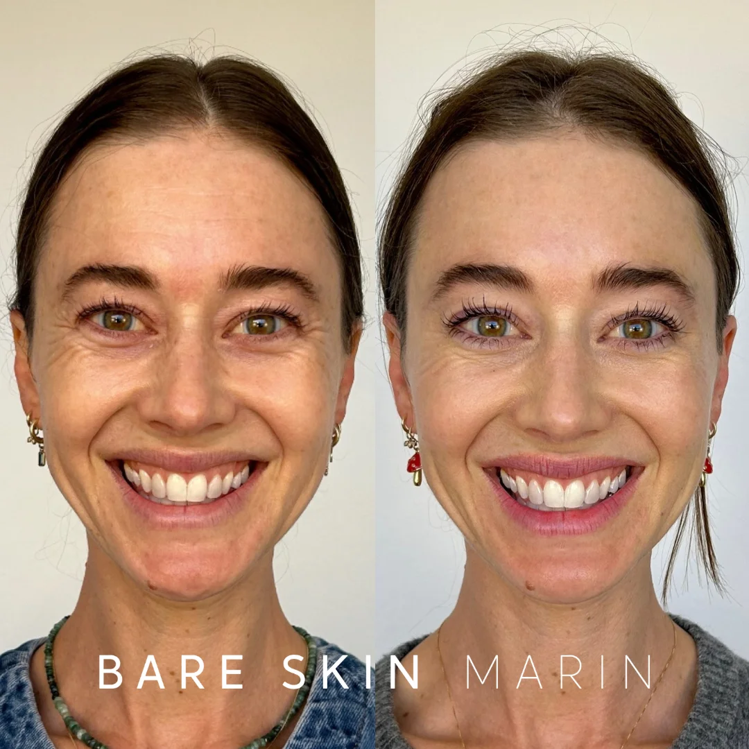 Wrinkle Relaxers before and after Images by Bare Skin Marin in Kentfield, CA
