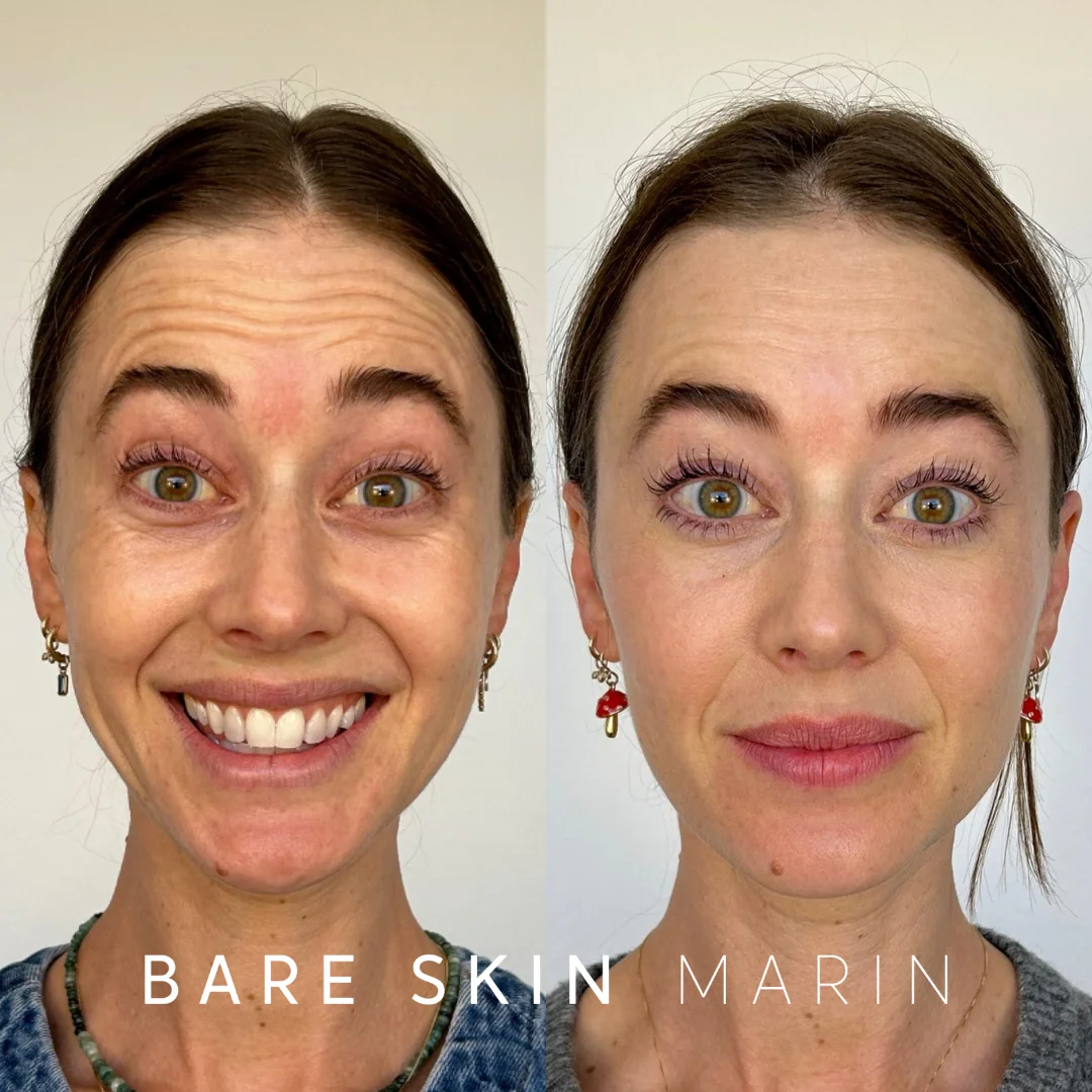 Wrinkle Relaxers before and after Images by Bare Skin Marin in Kentfield, CA