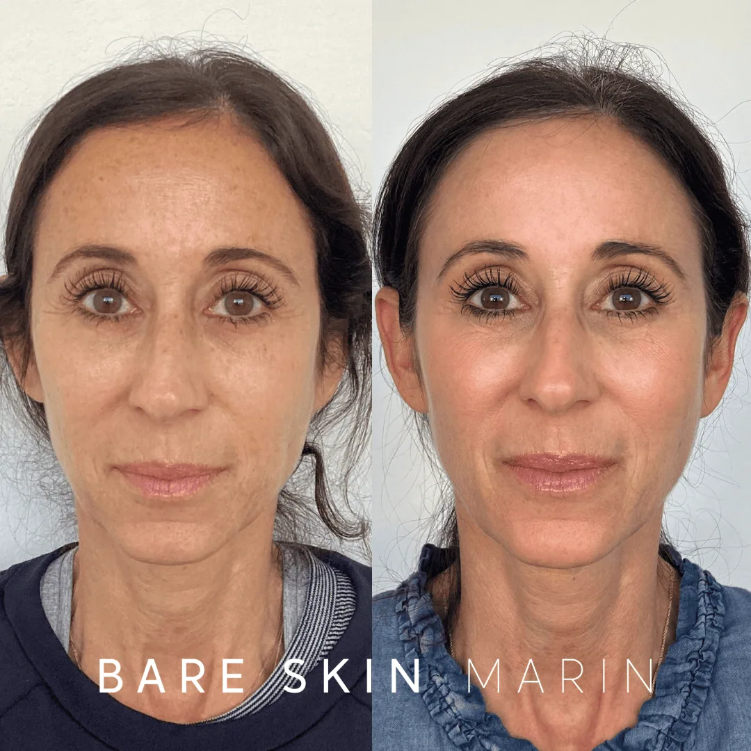 Wrinkle Relaxers before and after Images by Bare Skin Marin in Kentfield, CA