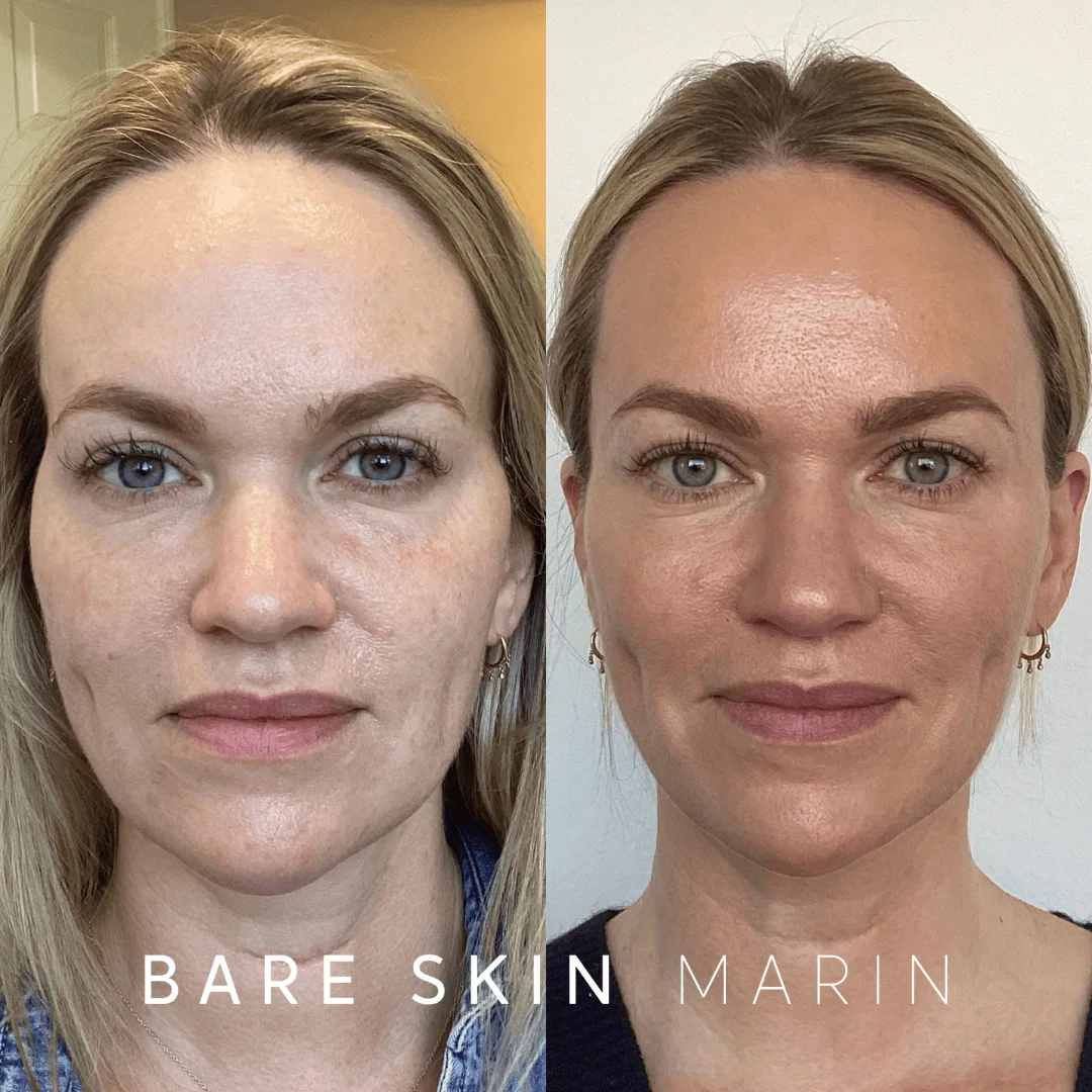 Wrinkle Relaxers before and after Images by Bare Skin Marin in Kentfield, CA