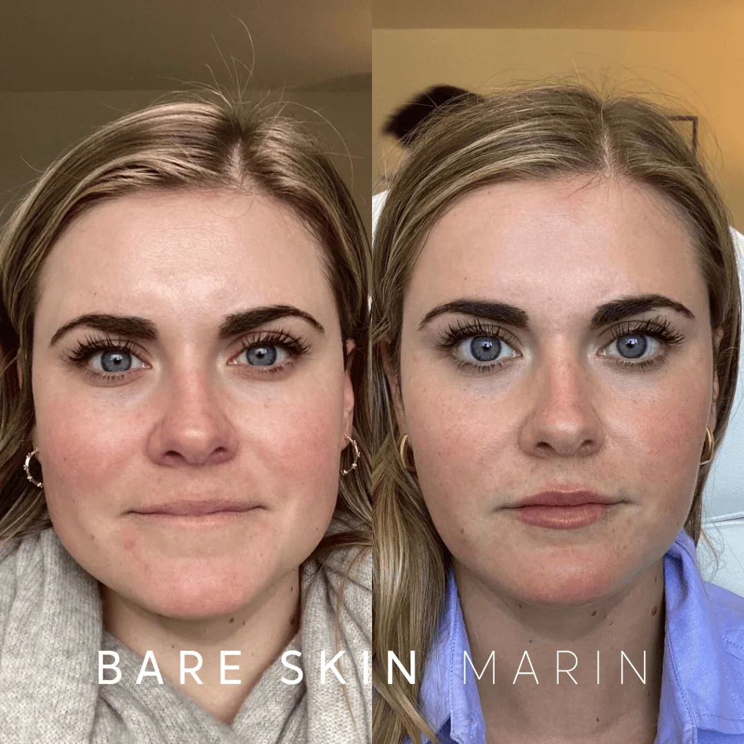 Jawline Slimming before and after Images by Bare Skin Marin in Kentfield, CA