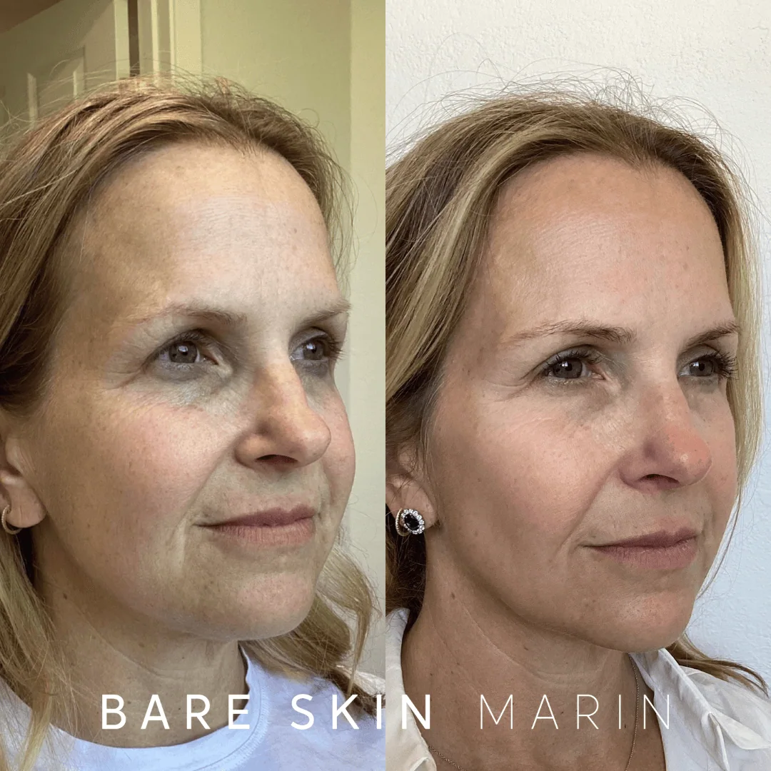 Wrinkle Relaxers before and after Images by Bare Skin Marin in Kentfield, CA
