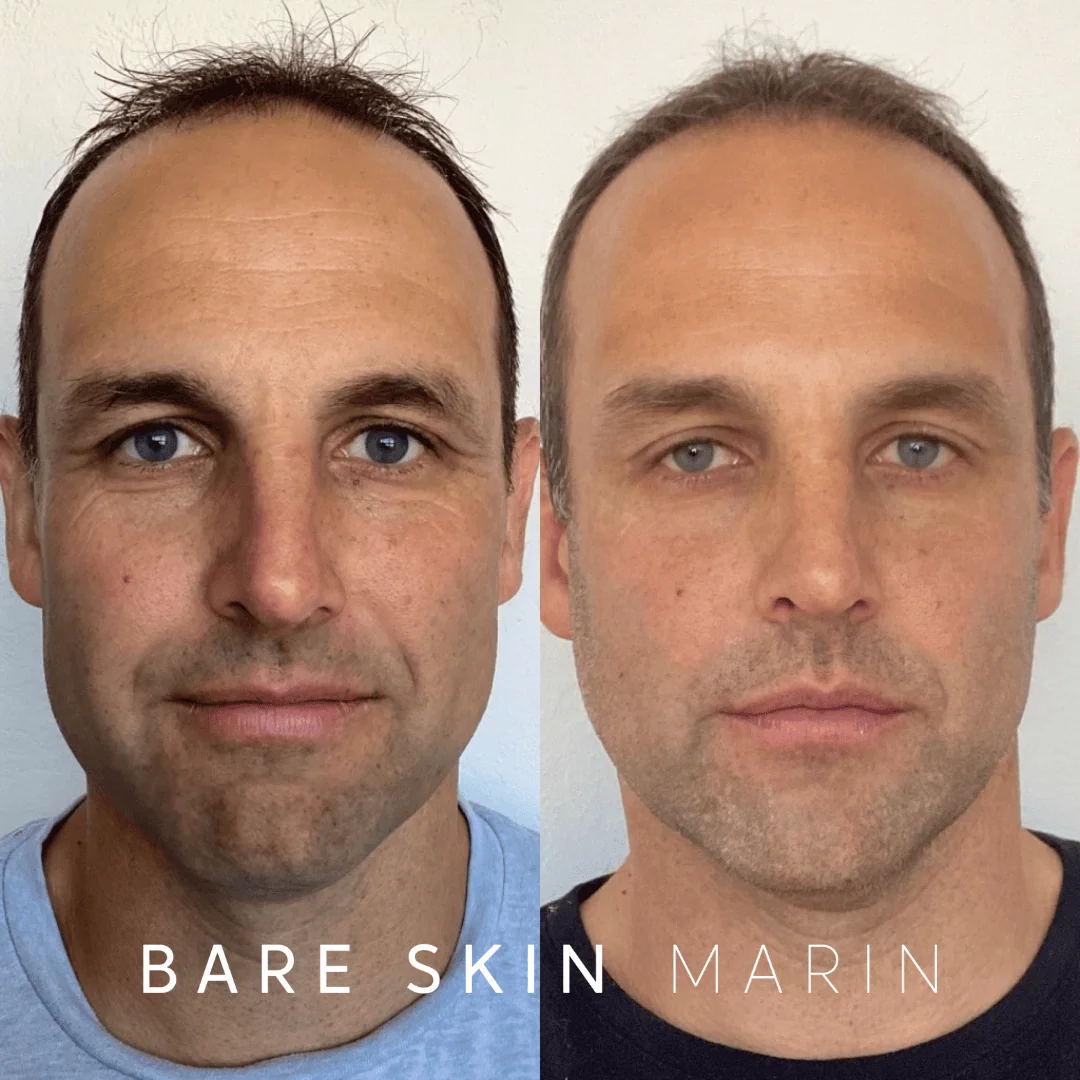 Skin Treatment before and after Images by Bare Skin Marin in Kentfield, CA