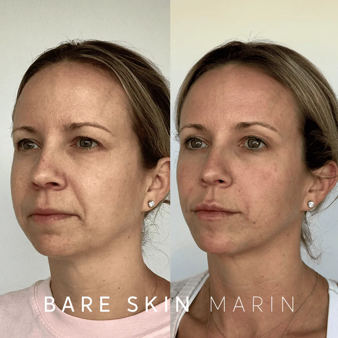 Wrinkle Relaxers before and after Images by Bare Skin Marin in Kentfield, CA