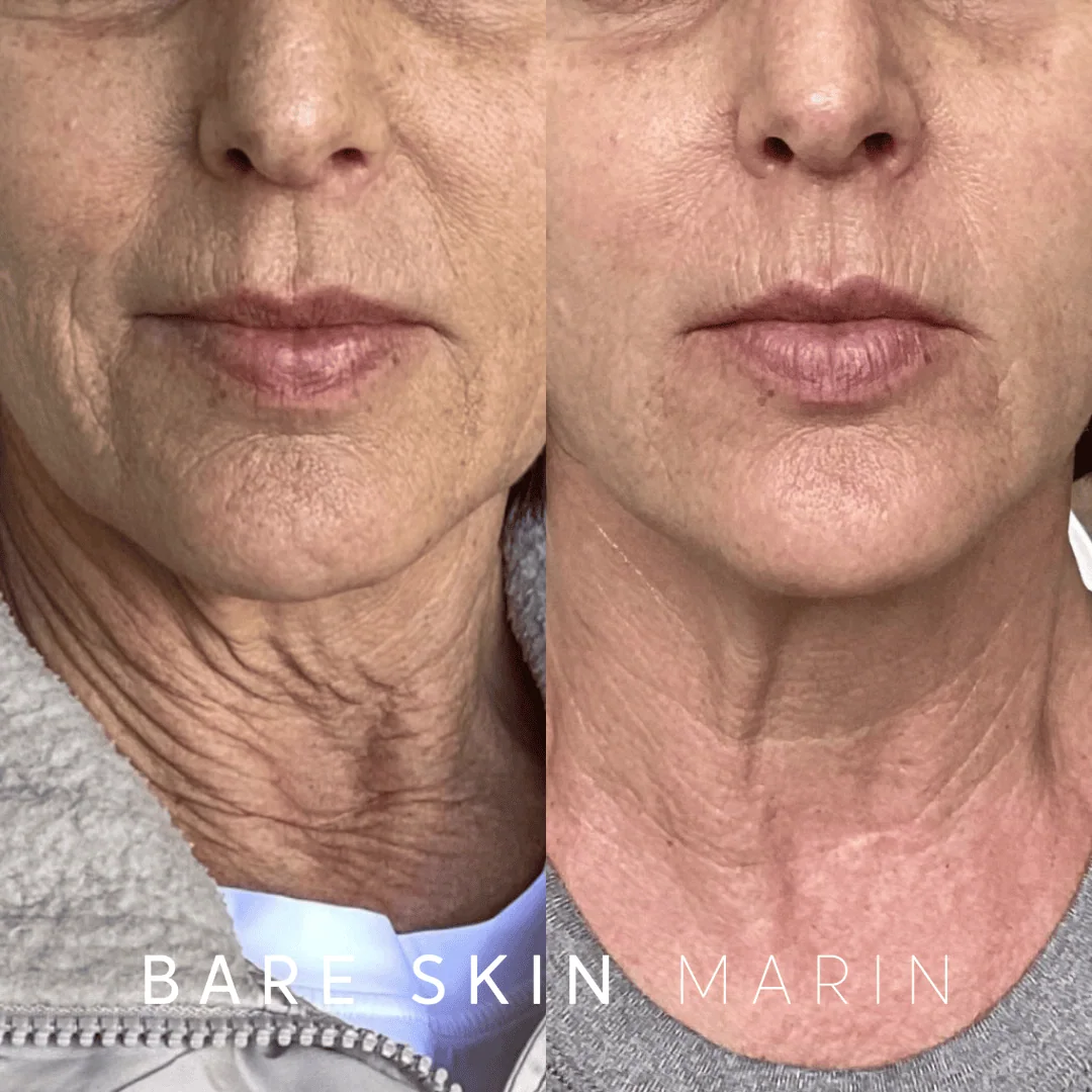 Wrinkle Relaxers before and after Images by Bare Skin Marin in Kentfield, CA