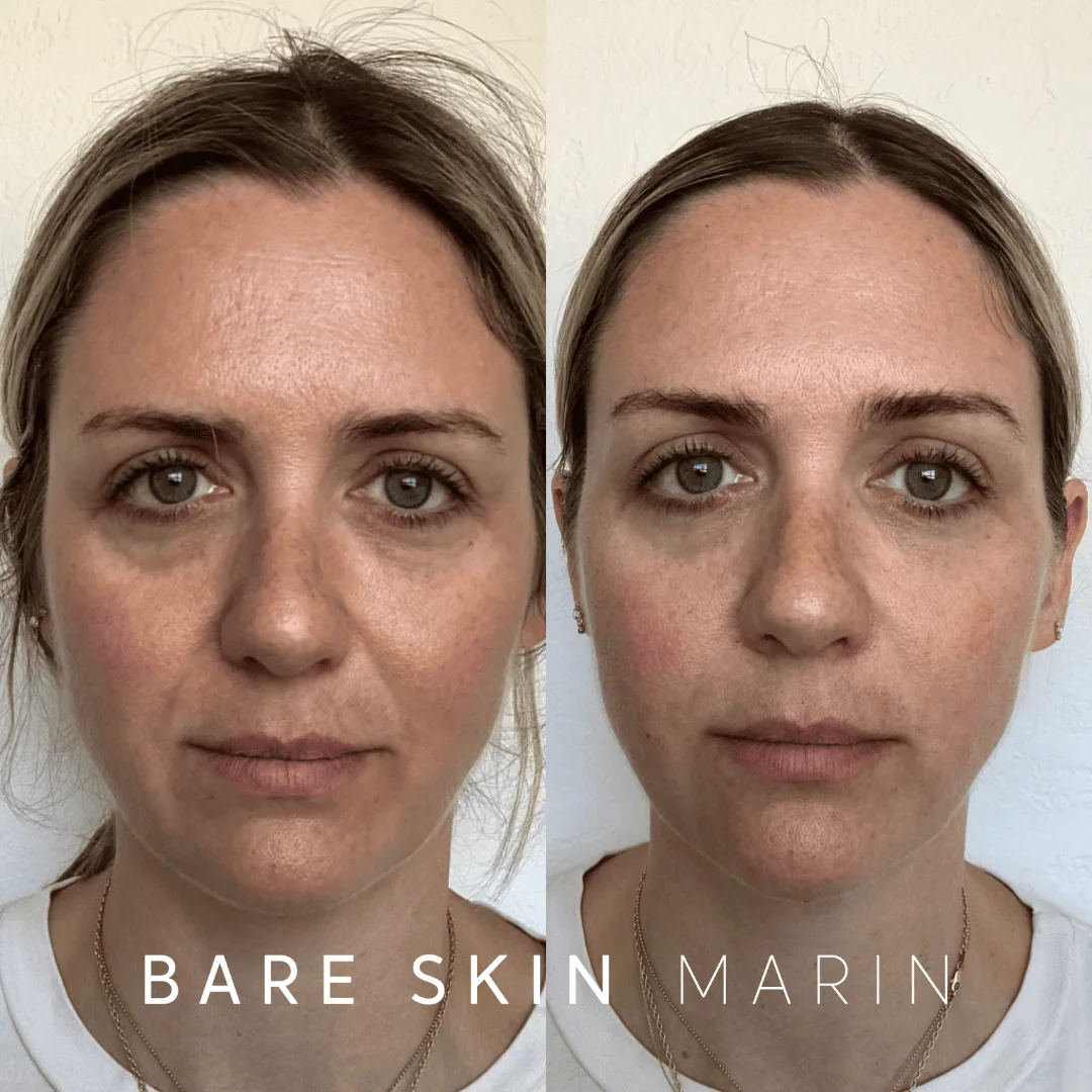 Wrinkle Relaxers before and after Images by Bare Skin Marin in Kentfield, CA