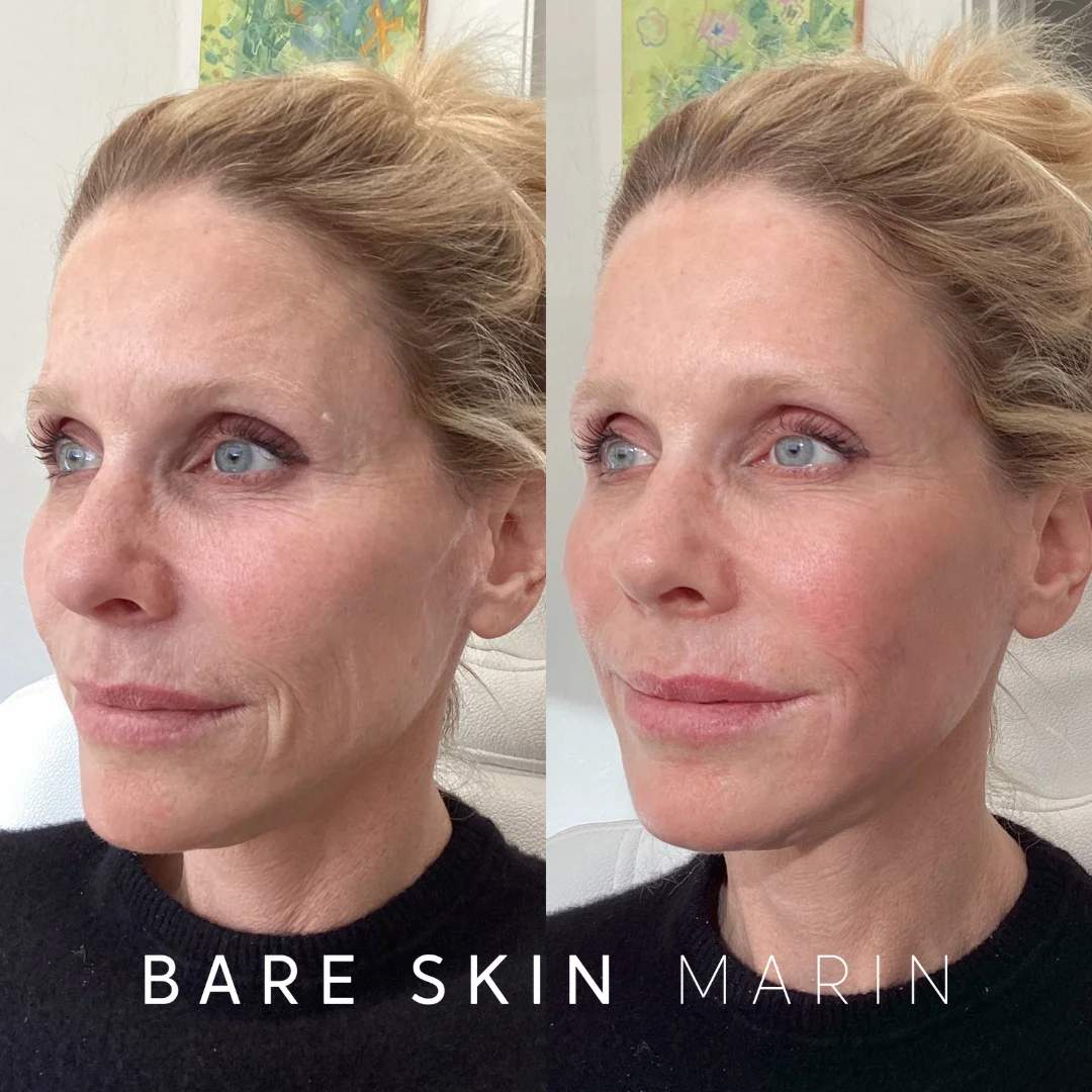 Aesthetic services before and after Images by Bare Skin Marin in Kentfield, CA