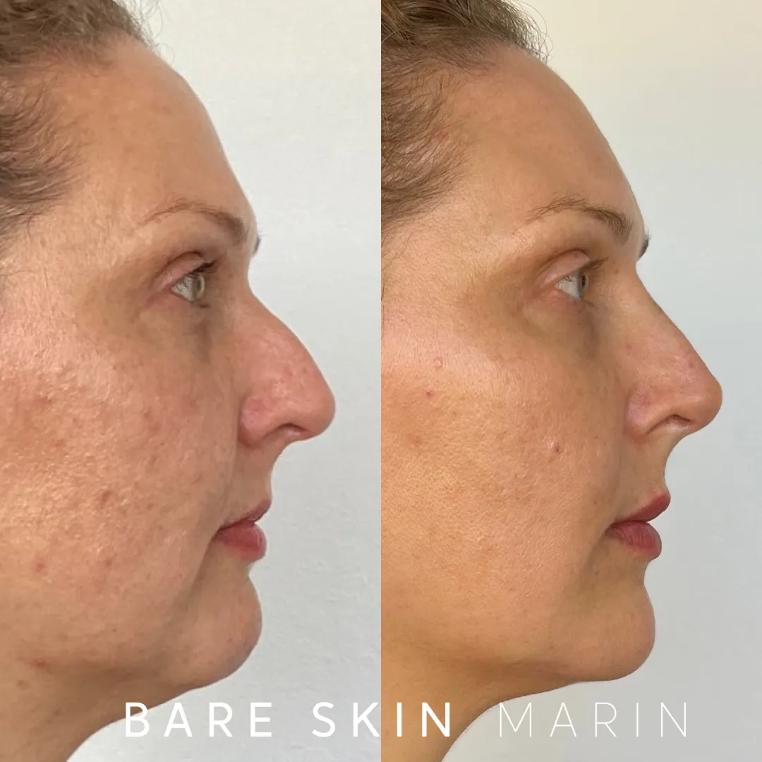 Skin Treatment in Kentfield, CA by Bare Skin Marin