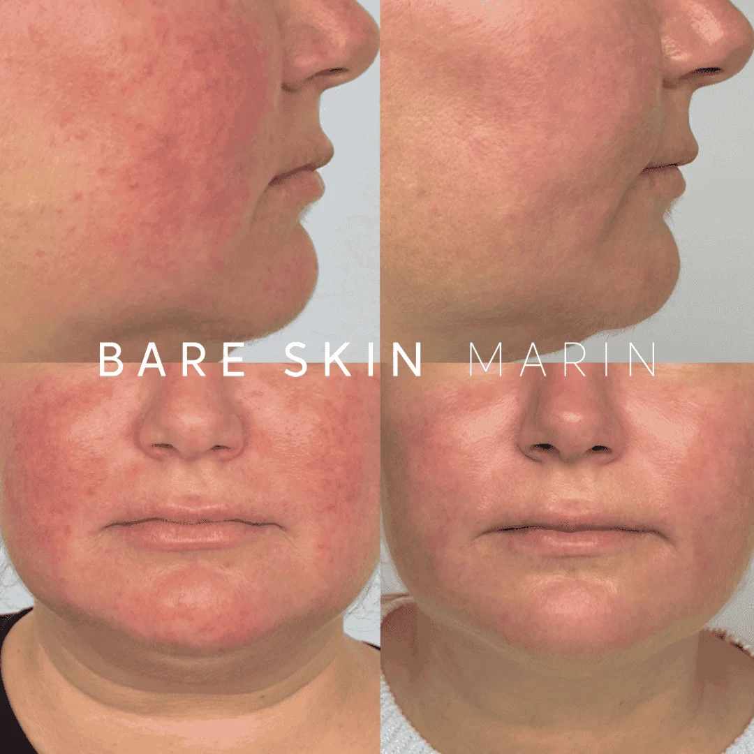 Skin Treatment in Kentfield, CA by Bare Skin Marin